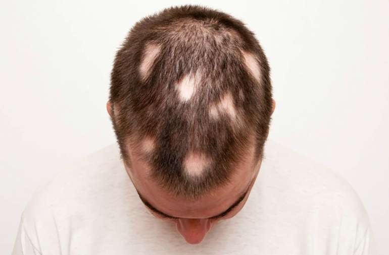 baldness treatment